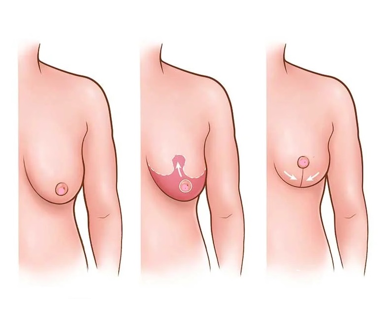 Complications of breast lift surgery