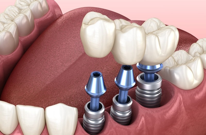 What should we do after dental implant implantation