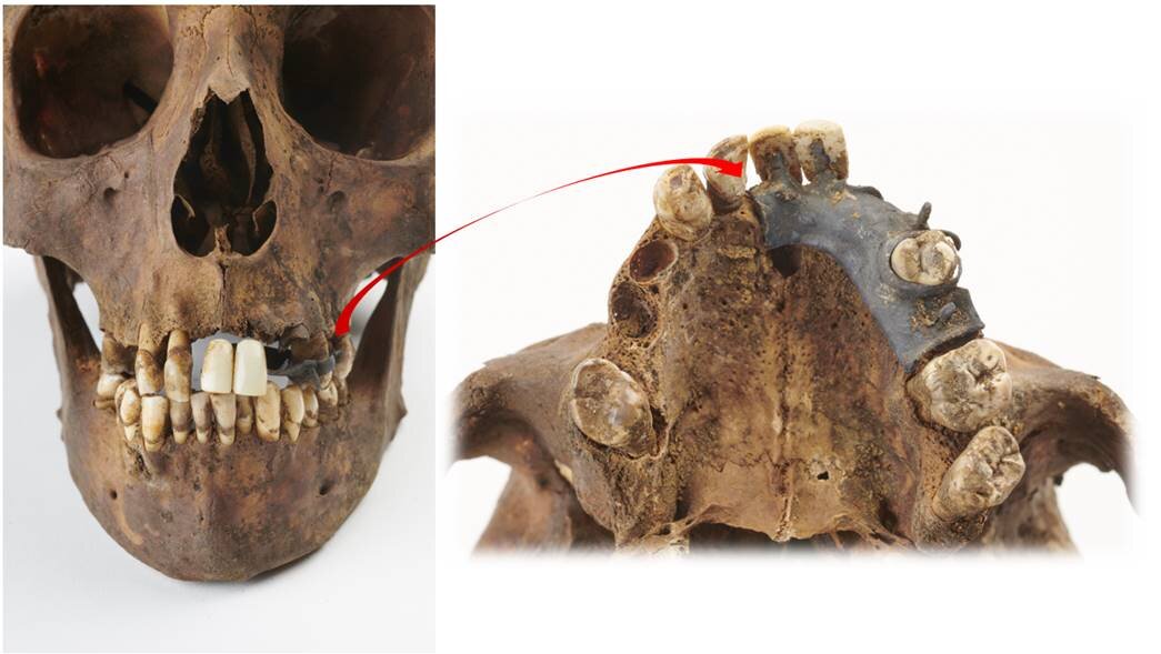 ساخت دندان مصنوعی از عضوی چندش‌آور در بدن مرده!