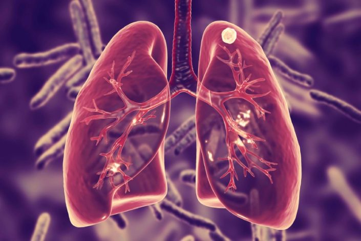 گزارش جدید سازمان جهانی بهداشت: سل همچنان قربانی می‌ گیرد